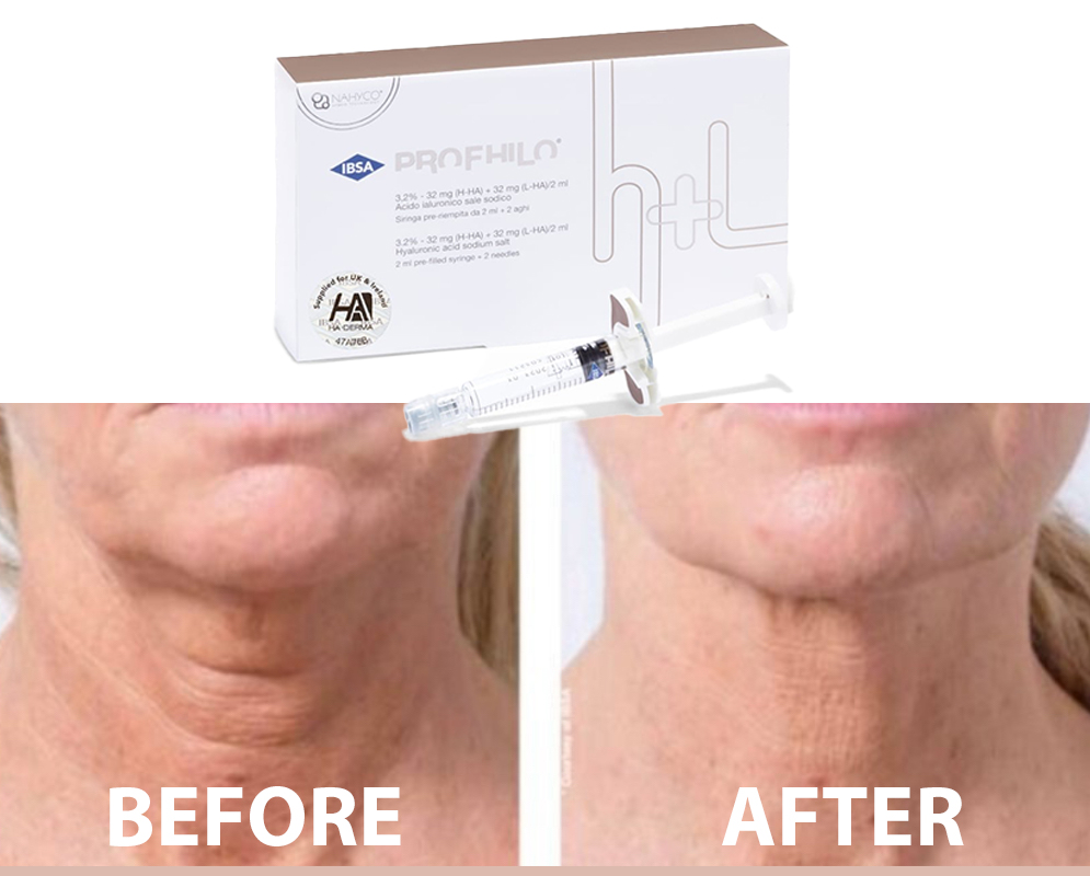 Profhilo_opulent_health Aberdeen